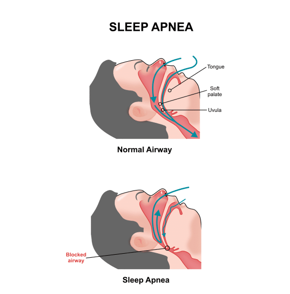 img-obstructive-sleep-apnea-Signs-and-Symptoms-of-Sleep-Apnea